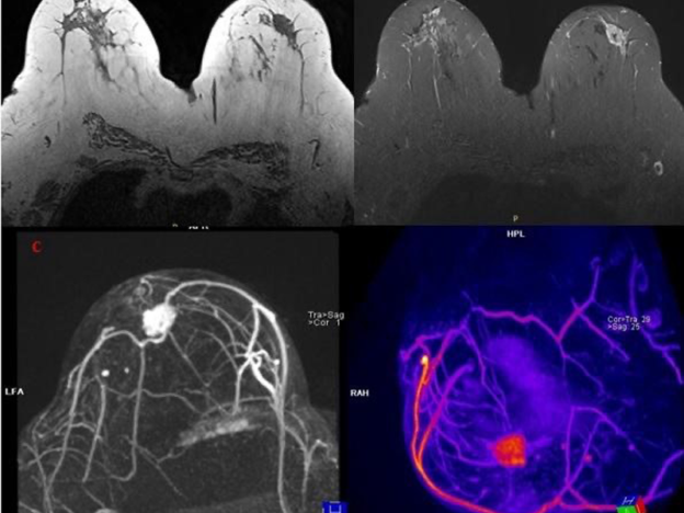 Episode 2: Abbreviated Breast Protocol in MRI course image