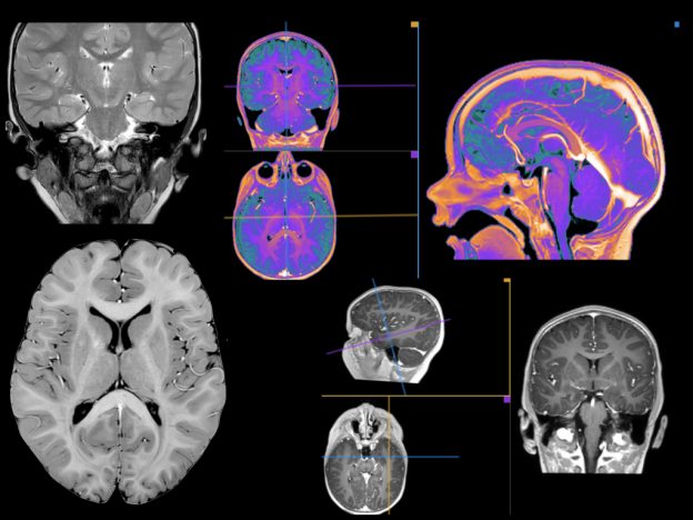 Gadolinium Based Contrast Agents (GBCAs) Use in Pediatric MRI course image