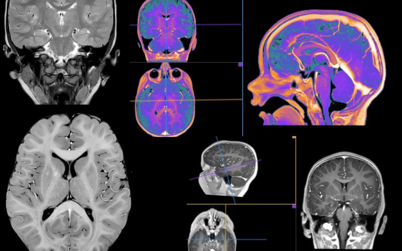 GadoliniumBased Contrast Agents (GBCAs) Use in Pediatric MRI