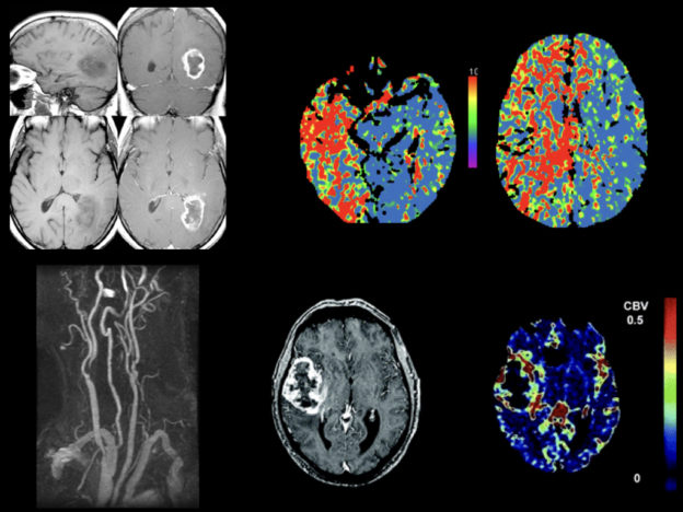Episode 9: Gadolinium-Based Contrast Agents (GBCAs) Use in Adult Neuro MRI course image
