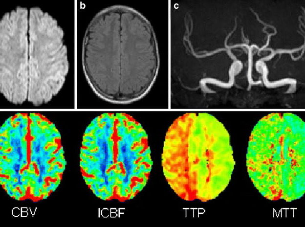 Episode 13: Perfusion MRI course image