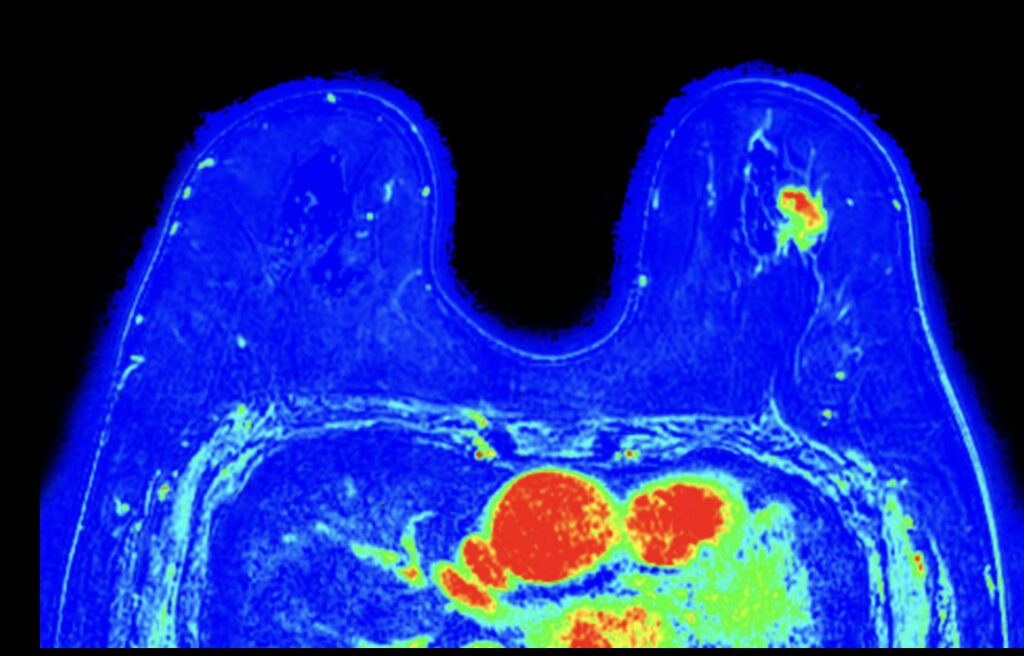 Episode 32 Breast MRI
