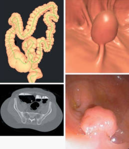 Episode 38 CT Colonography (CTC)