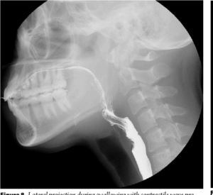 Radiopaque Episode: Modified Barium Swallow (MBS)