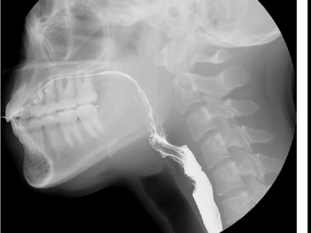 Radiopaque Episode: Modified Barium Swallow (MBS) course image