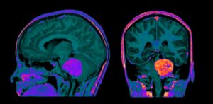 Episode 40 Neuro Protocols with Gadopiclenol