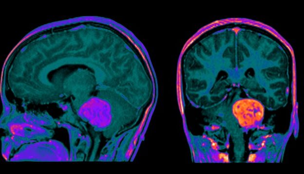 Episode 40 Neuro Protocols with Gadopiclenol course image