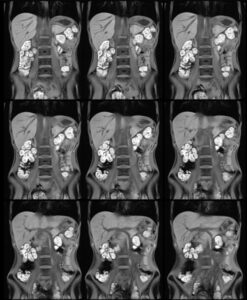 Episode 41 Body MRI Update